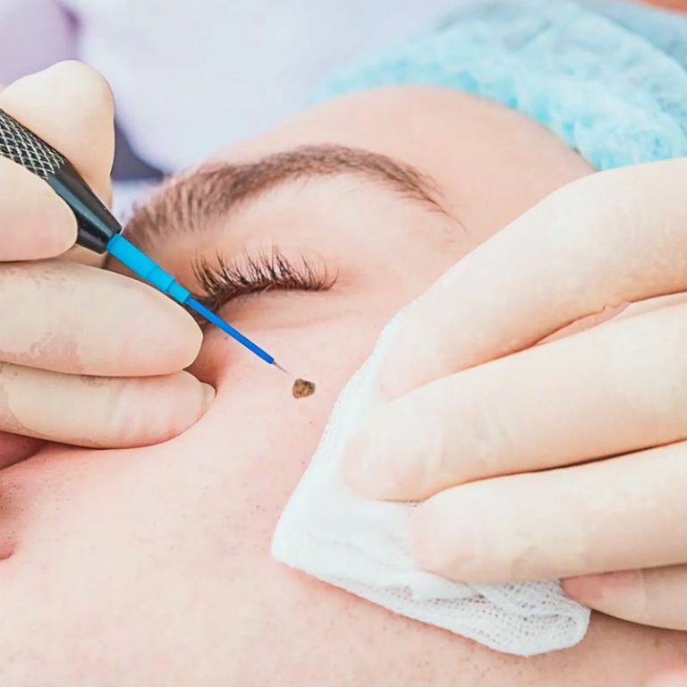Mole_Milia Removal
